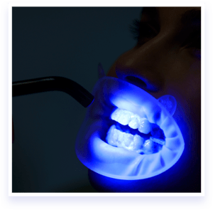 Advanced teeth whitening treatment 