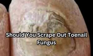 Read more about the article Should You Scrape Out Toenail Fungus